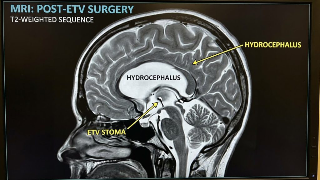 ETV Surgery for Hydrocephalus