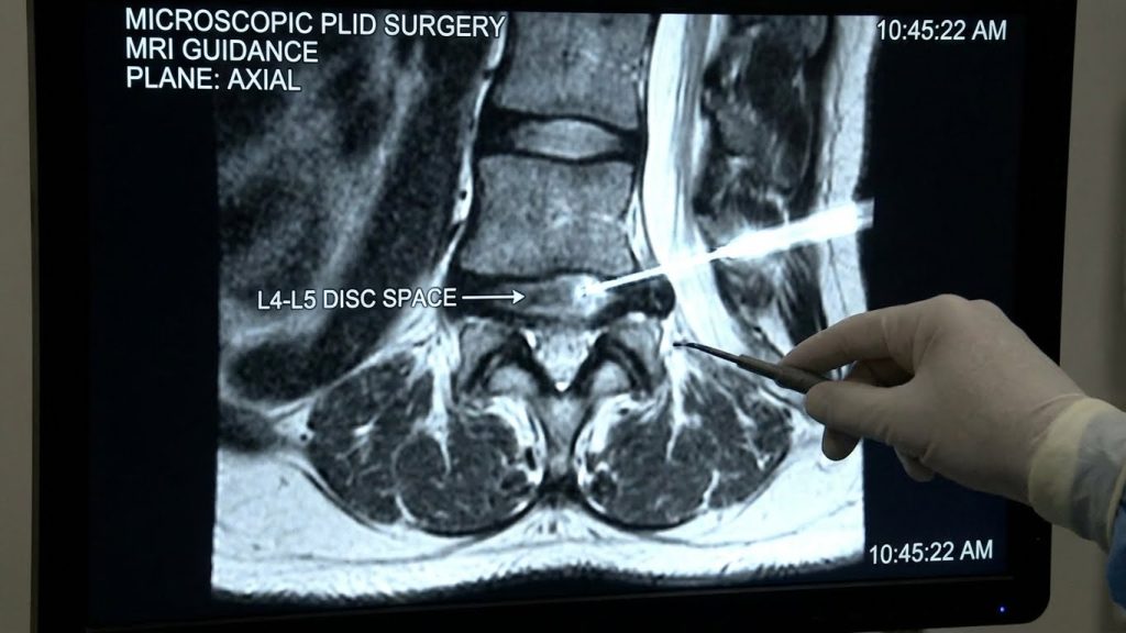 Microscopic PLID Surgery