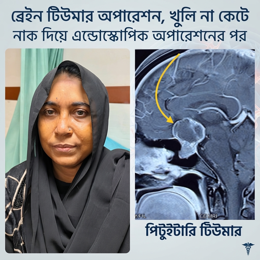 মাথার খুলি না কেটে নাক দিয়ে নিখুঁত এন্ডোস্কোপিক ব্রেইন টিউমার অপারেশন
